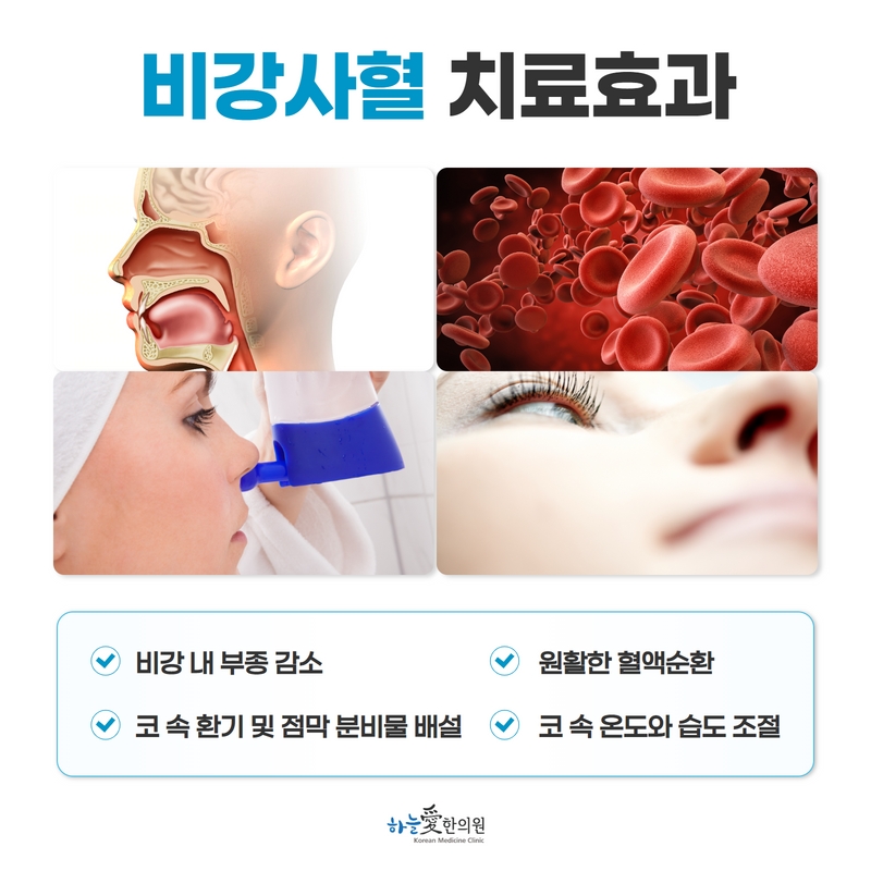 비강사혈 관련 안내 항목과 사진을 정리한 원본 이미지