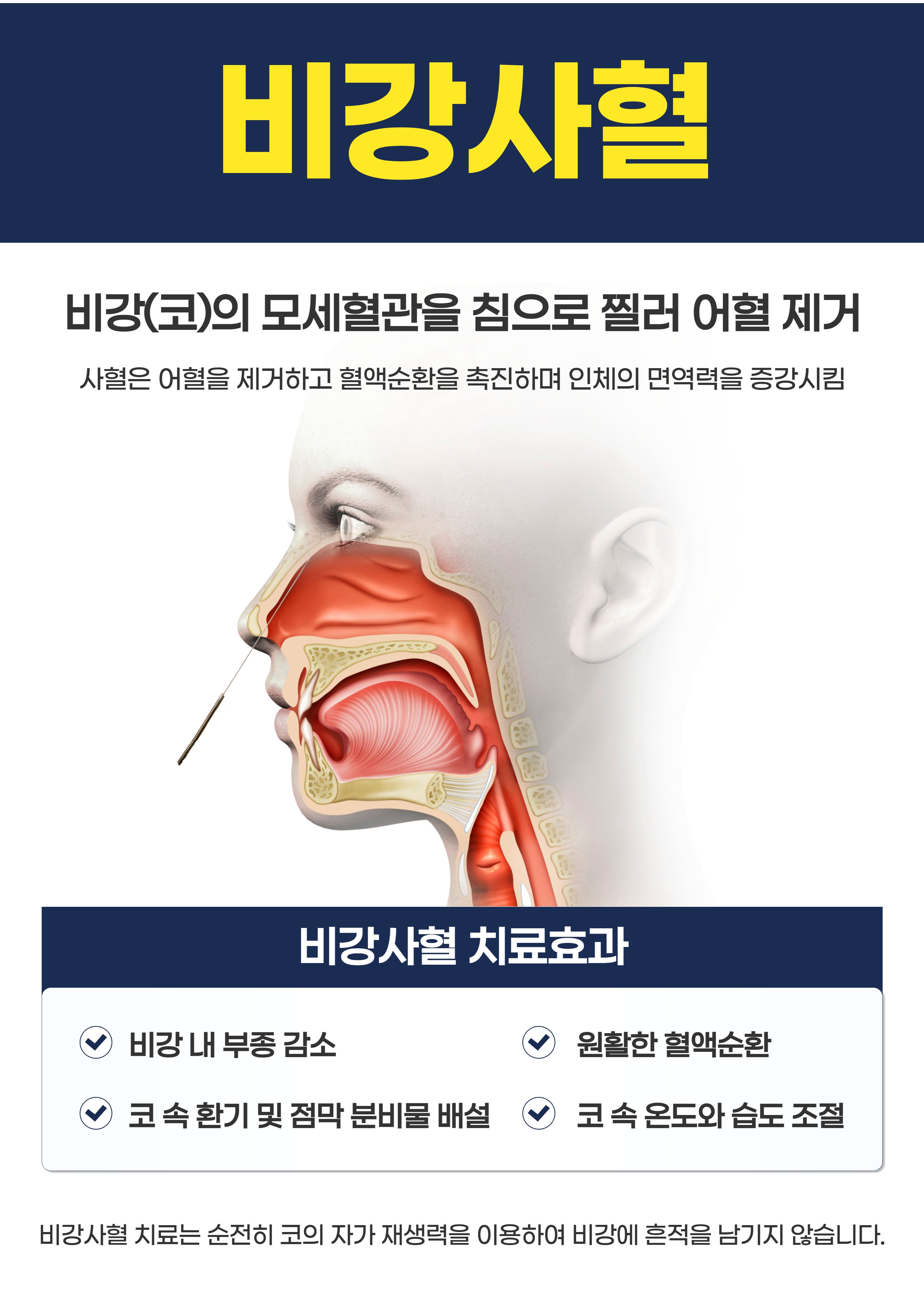 비강사혈의 개념과 관련 항목을 세로형으로 정리한 원본 안내 이미지