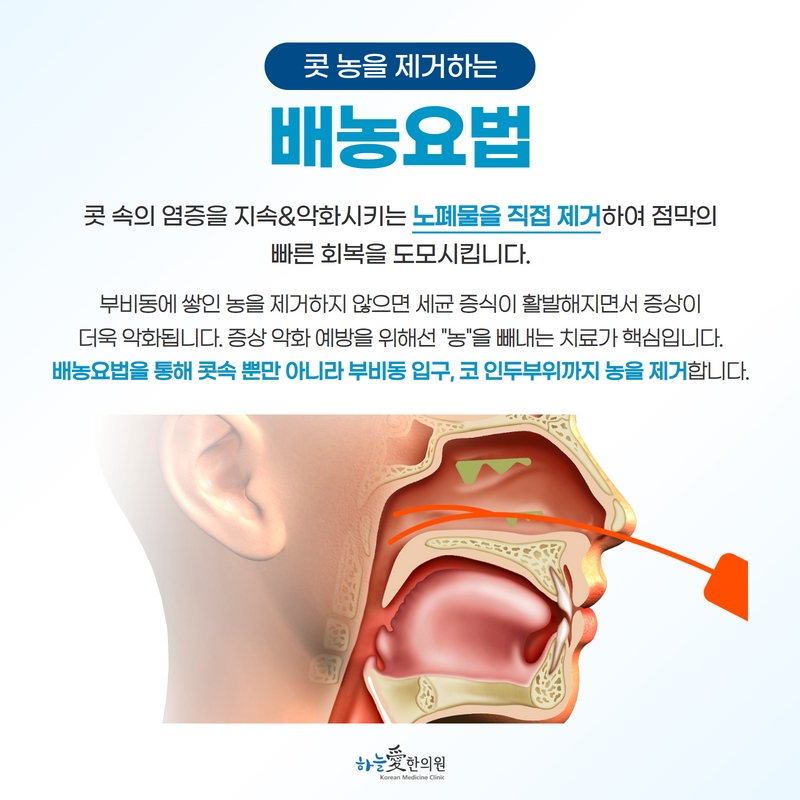 배농요법의 방법과 적용 부위를 정리한 원본 안내 이미지