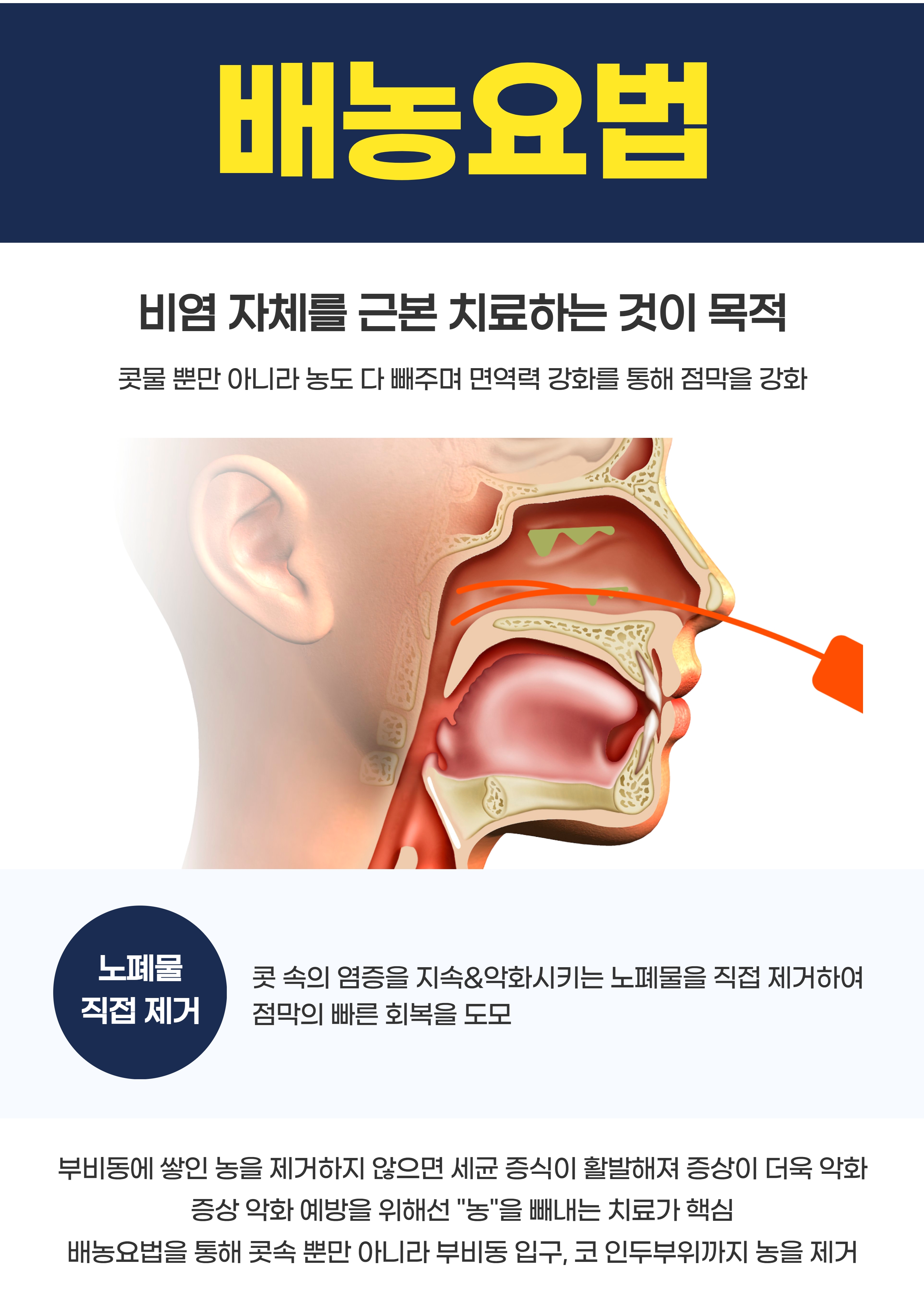 배농요법의 개념과 관련 항목을 세로형으로 정리한 원본 안내 이미지