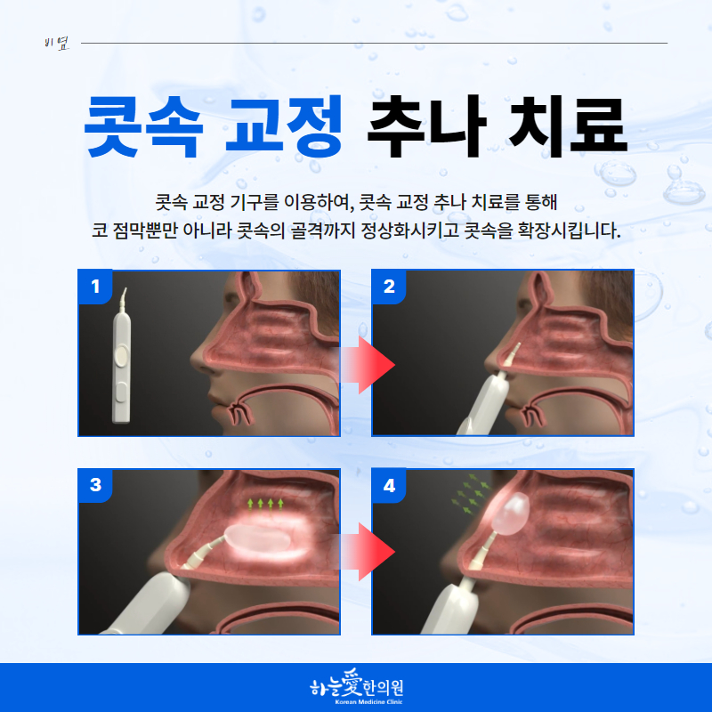 코속교정추나 기구와 적용 과정을 네 단계로 보여주는 원본 안내 이미지