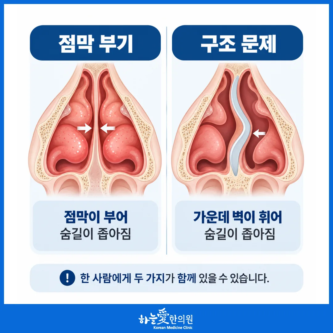 코막힘 두 갈래 점막 부기와 코 안 구조 비교 개념도
